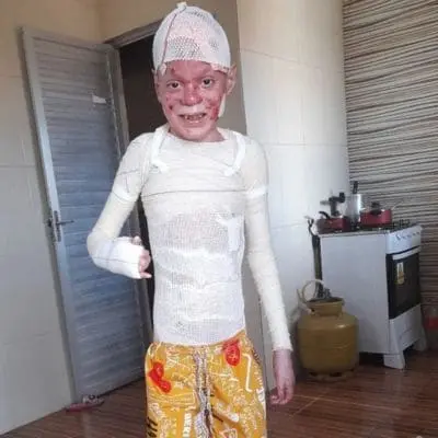Gabriel com curativos